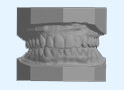 Impressions of your teeth for custom ClearCorrect aligners