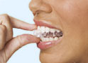 Wearing progressive versions of your ClearCorrect invisible aligner tray