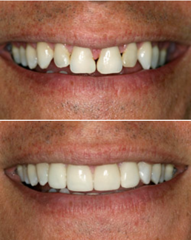 Porcelain veneers