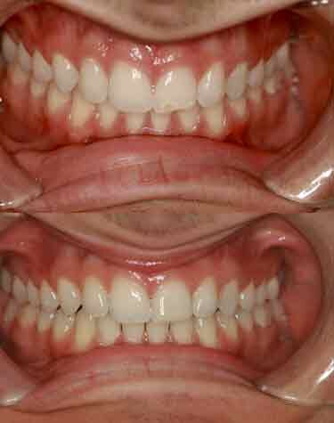 Tooth Bonding Boca Raton