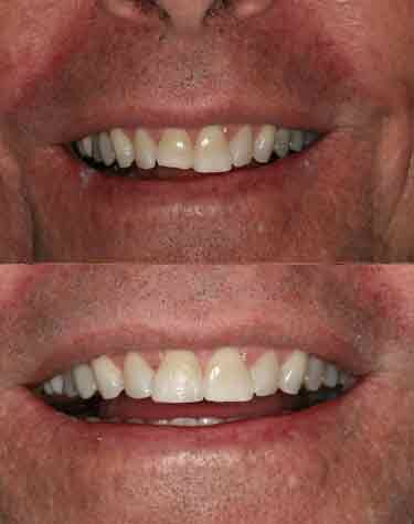 Tooth Bonding Boca Raton