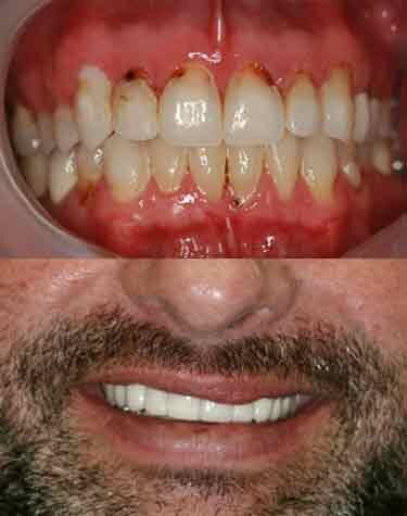 Dental Crowns Boca Raton