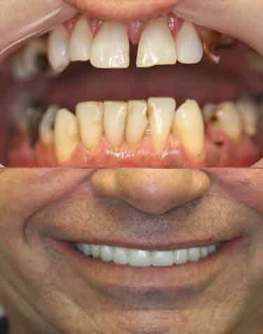 Dental Crowns South Florida