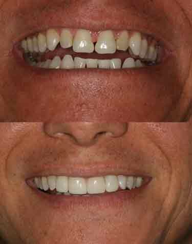 Dental Crown Boca Raton