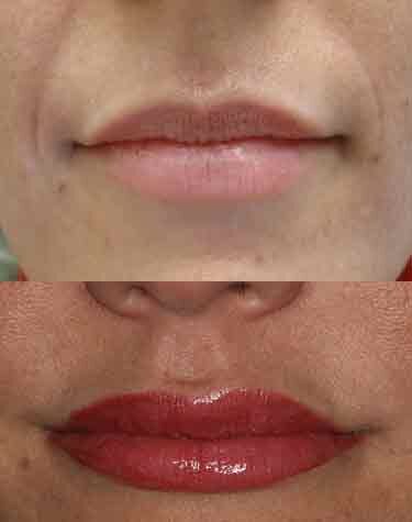 Lip Fillers Boca Raton 
