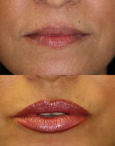Lip Injections Boca Raton 