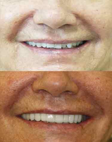 Veneer-2_PA