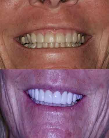 Veneers Boca Raton